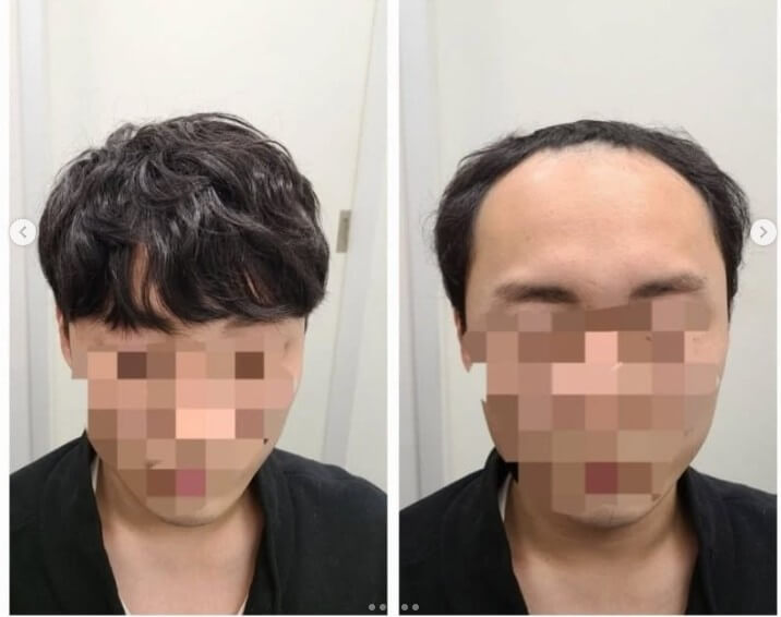 매일아침 가발 착용 전 후