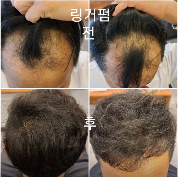 모닝와이드 탈모전문미용실 궁금했던잡스 위치 가격 탈모커버펌 전 후 모습