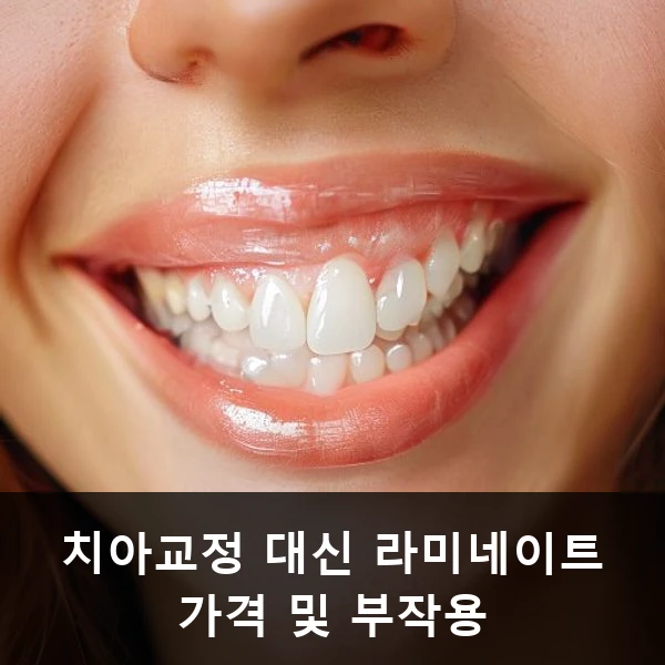 치아교정 대신 라미네이트 가격 및 부작용 관련 대표 이미지